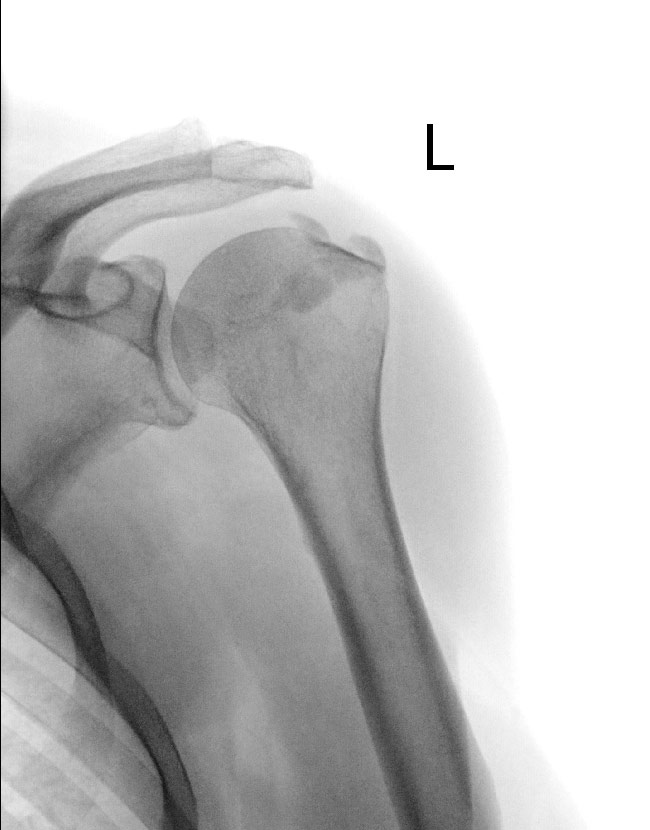 Röntgenbild einer Tendinitis calcarea: Kalkablagerungen in der Rotatorenmanschette
